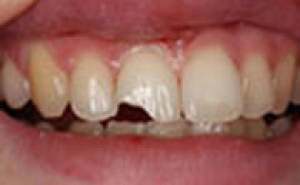 Dent cassée, dent accidentée